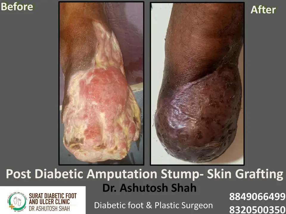 Diabetic Foot  PPT 3 checked by sir.pptx-21.webp